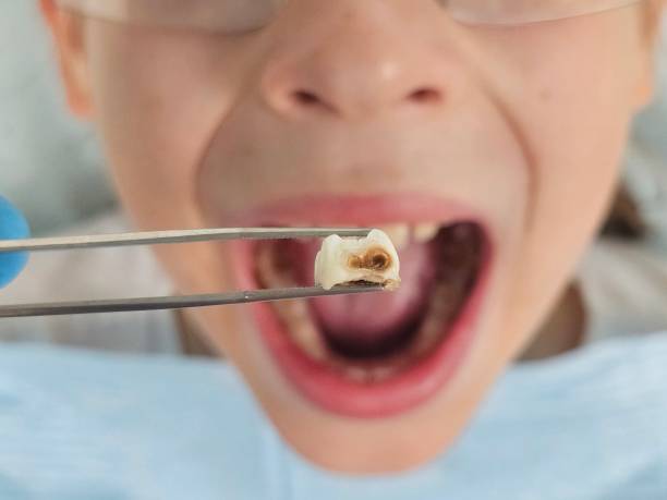 Best Emergency Dental Care for Abscessed Tooth in Mckinley, PA